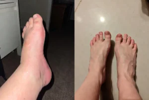 pés-e-tornozelos-inchados-e-pés-e-tornozelos-saudáveis-após-usar-o-protocolo-natural-3
