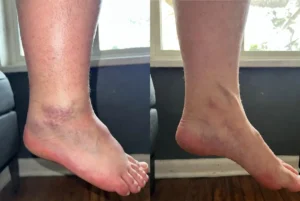 pés-e-tornozelos-inchados-e-pés-e-tornozelos-saudáveis-após-usar-o-protocolo-natural-4