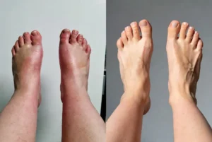 pés-e-tornozelos-inchados-e-pés-e-tornozelos-saudáveis-após-usar-o-protocolo-natural-5