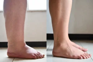 pés-e-tornozelos-inchados-e-pés-e-tornozelos-saudáveis-após-usar-o-protocolo-natural-6
