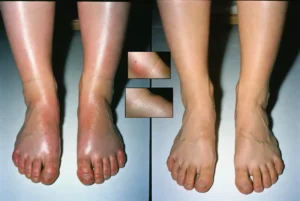 pes-e-tornozelos-saudaveis-após-usar-a-formula1